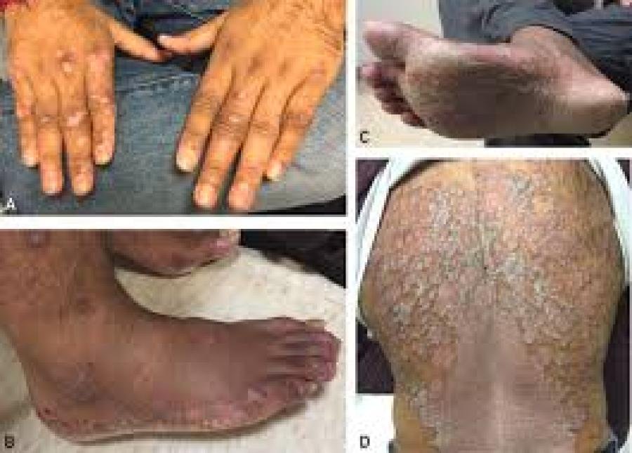 എറണാകുളം ജില്ലയില്‍ ചിക്കുന്‍ഗുനിയ കേസുകള്‍ പടരുന്നു.