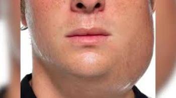 തൊടുപുഴയിൽ കുട്ടികൾക്കിടയിൽ മുണ്ടിനീര് പടരുന്നു